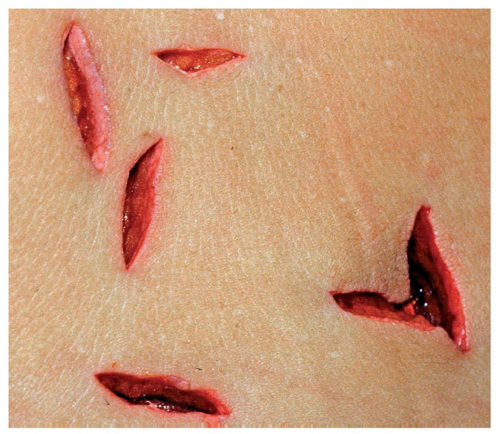 CRIMINALISTICA: HERIDAS POR ARMA BLANCA